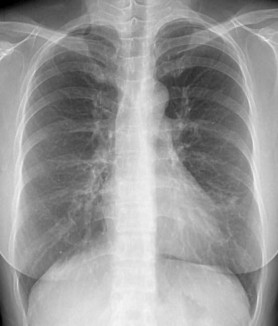 Also note bronchiolitis of small centrilobular nodules in the superior segments of the both lower lobe.