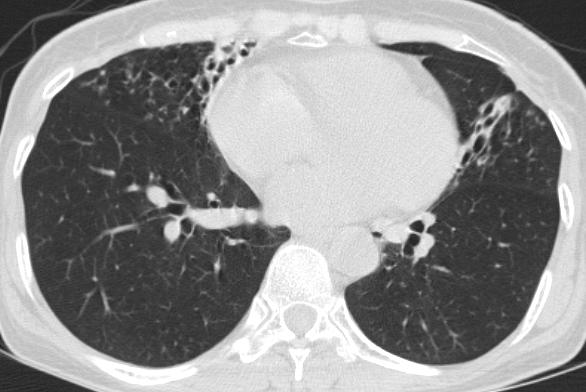 - 고원중외 1 인 : 비결핵항산균폐질환의진단과치료 - Figure 3. Mycobacterium abscessus pulmonary disease in a 61-year-old woman.