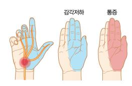 손목굴을통과하는정중신경 (median nerve) 이손목굴의협착에의해압박당하는질환이손목굴증후군이다.