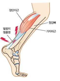 발과발목인대손상의가장일반적인원인은발목염좌 (ankle sprain) 이며,