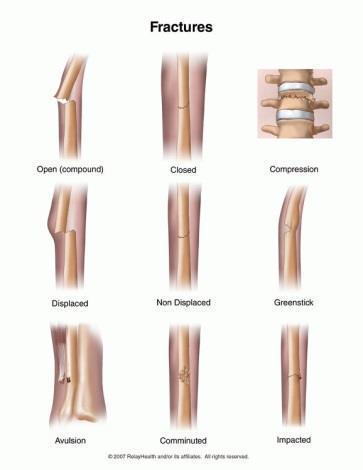 골절 Fracture 1. 근뼈대계통질환 뼈의연속성이완전또는불완전하게소실되거나선상의변형을일으킨상태이다. 골절의분류골절은정도에따라다음과같이분류한다.