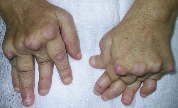 류마티스관절염 rheumatoid arthritis 아직까지원인이불분명한대표적인자가면역성질환 (autoimmune disease) 이고, 보통전체인구에서약 1~2% 정도의발생빈도를보이며, 여성이남성보다약 3~4 배정도발생빈도가높다. 뼈관절염과비교하여상대적으로젊은층에서도많이발생하는질환이다.