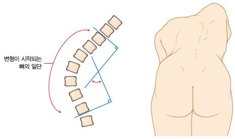 척주옆굽음증 scoliosis 척추가옆으로구부러진변형으로해부학적중앙축으로부터척추가가쪽으로굽음또는치우침되며, 돌림변형을동반하는질환이다.