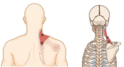 근막통증증후군 myofascial pain syndrome 근육을싸고있는근막에존재하는유발점 (trigger point)