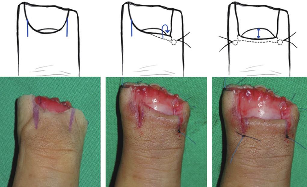 J Korean Soc Surg Hand Vol. 22, No. 1, March 2017 flap) 은근위손톱주름 (proximal nail fold) 에피판을작성하여근위부로후퇴시키는술식으로, 간단하고안전하면서도효과적으로손톱의길이를늘일수있는방법이다.