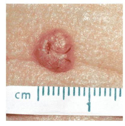 Clinical lesion Superficial lesion ³ 1 cm :