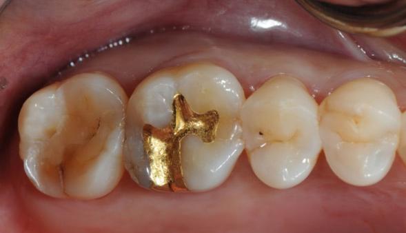 Delivery of zirconia crown.