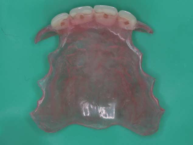 Photographic view of flexible denture. Ⅲ. 총괄및고찰 6개이상의치아가선천적으로상실된 oligodontia 는 0.3-0.4% 의매우낮은유병율을보인다 4).