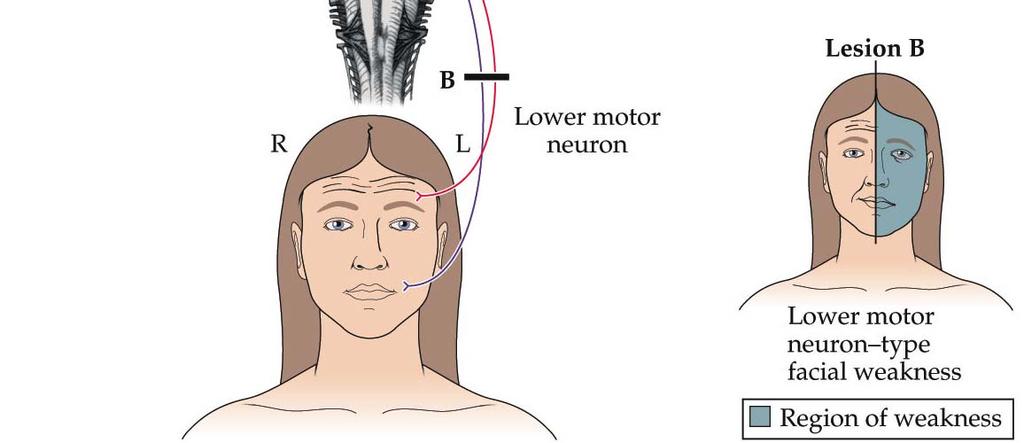 피질뇌간섬유 ) 얼굴윗부분표정근육담당 >-- 좌우양쪽대뇌피질시작