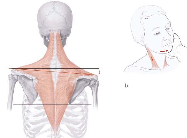 XI. Accessory nerve( 부신경, 더부신경 ) 운동신경두 part cranial part(cranial root, 뇌근 ) spinal part(spinal root, 척수근 ) Cranial root medulla 에서 X 바로아래에부착해있음 nucleus ambiguus 중하부에서시작 -- vagus nerve 에합쳐짐 --<