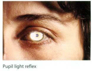2. Consensual light reflex(
