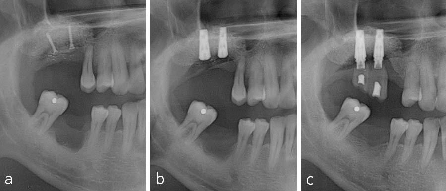 Fig. 4. Clinical photographs a. pre-operative view, b. intra-operative view of screw placement for tenting effect, c. flap closure, d. bone graft donor site (mandibular ramus), e. obtained bone.