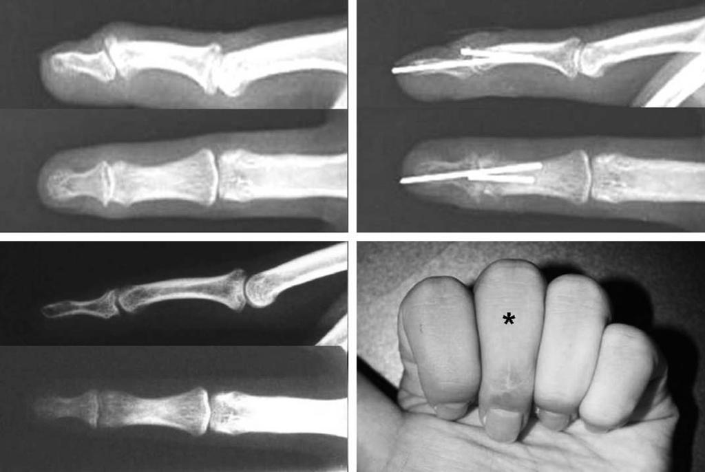 Fig. 3. A case of 23 year-old woman, 10 week-delayed. (A) Preoperative radiograph shows Wehbe -Schneider classification IIB mallet fracture.