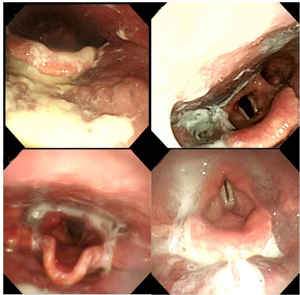 the airway Penetration 3 Material enters the airway, remains above the vocal folds, and is not ejected from the airway 4 Material enters the airway, contacts the vocal folds, and is ejected from the