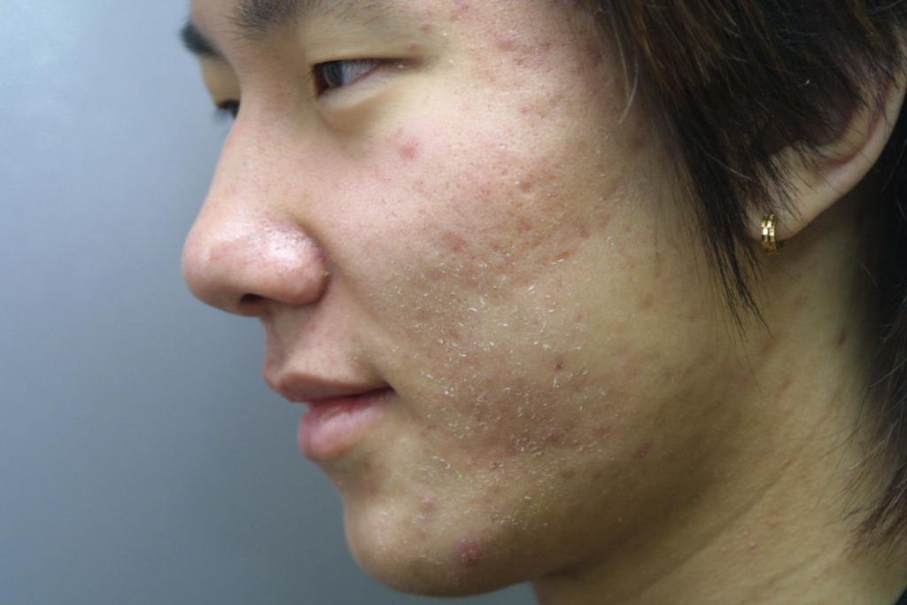 44 benzoyl peroxide lotion 은 Propionibacterium acne 를강력히억제하여유리지방산을총 50% 감소시 키는데테트라사이클린으로는 을 6주를요하였던것 2 주만에같은효과를보았다고밝히고있다.
