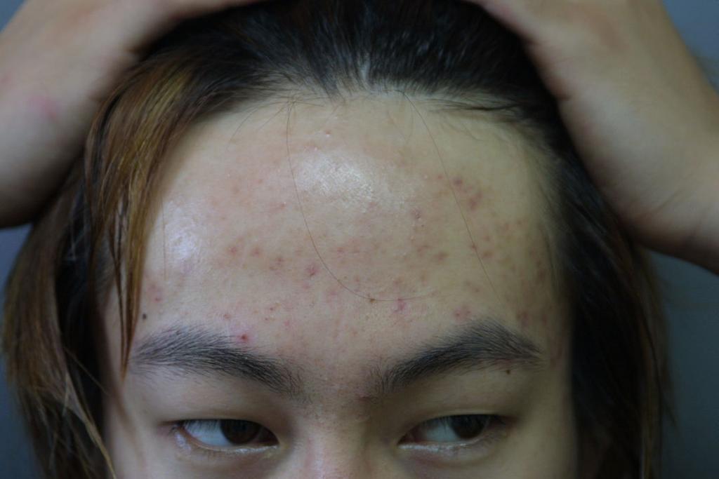대한피부미용학회지제3권제1호 45 (B) after 4weeks Group B: The respondents applied on acne skins 5% benzoyl peroxide lotion and were cared acne treatment as well.