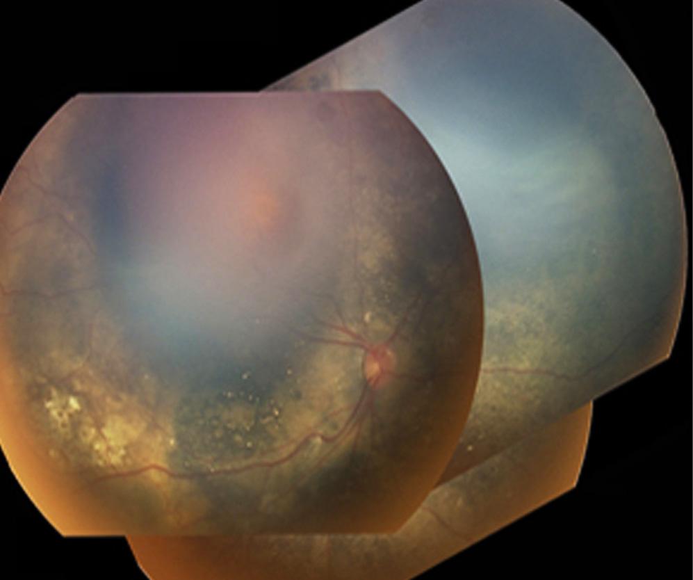 - 대한안과학회지 2011 년제 52 권제 1 호 - Figure 3. Fundus photograph taken 2 months after operation. () Right eye, flat.