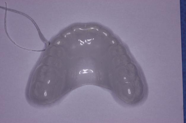 Fig. 2. Soft silicone mouthguard with dental floss. Fig. 3. Follow-up after 1 month. Almost wound healing following appliance therapy but starting biting lower lip after lost the appliance.
