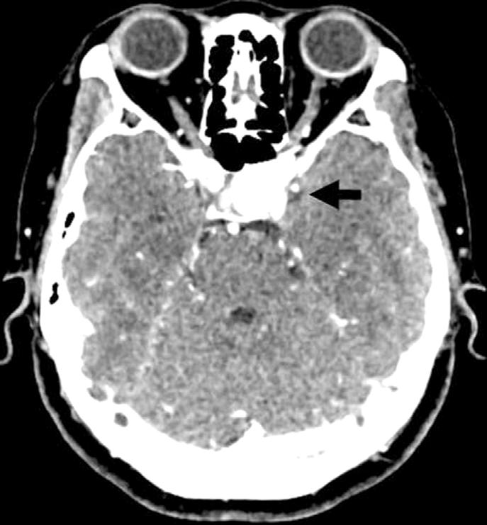 - 김경남외 : 단안비측반맹으로발현된내경동맥류 - A B C Figure 4. Brain CT images of axial section (A) and coronal section (B) shows 2.