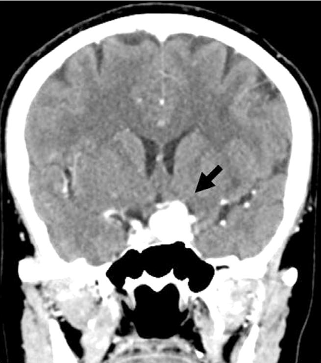 Brain CT angiography (C) demonstrates large aneurysm located on the paraclinoid portion of the left internal carotid artery (white arrow). 모두정상범위안에있었고이측망막신경섬유층의두께는좌안이유의하게얇아진것으로나타났다 (Fig. 3).