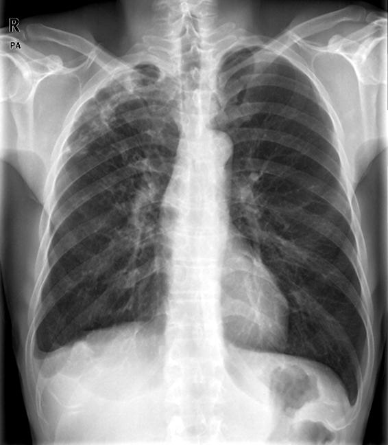 박성수외 : Poncet s Disease in Pulmonary Tuberculosis Fig. 1. Chest X-ray showing cavitated pulmonary tuberculosis in the right upper lobe, initial (A) and after 4 months (B).