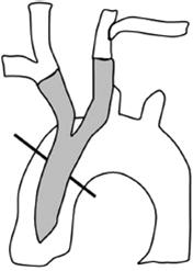 - 대한내과학회지 : 제 89 권제 4 호통권제 662 호 2015 - A B C D Figure 2. Zone 0 involves the ascending aorta and proximal arch to the BA. Zone 1 involves the area between the BA and the LCCA.