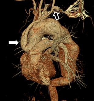 aorta to the descending thoracic aorta in a telescopic fashion to exclude extensive aortic aneurysm (E, F).