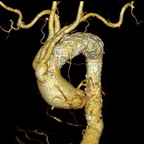 - Woong Chol Kang. Endovascular therapy for TAA - A B Figure 4.