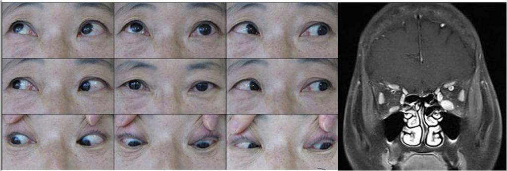 Figure 2. Ocular motility dysfunction. The patient shows a limitation of elevation in the left eye due to the enlargement of the inferior rectus muscle demonstrated by orbital MRI. 와색각이상이서서히발생한다.