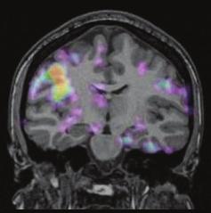 수술전검사로시행한 4일간의비디오-뇌파집중감시검사에서발작간 (interictal) 간질파 (epileptic discharges) 는관찰되지않았고간질발작은 3회기록되었다.