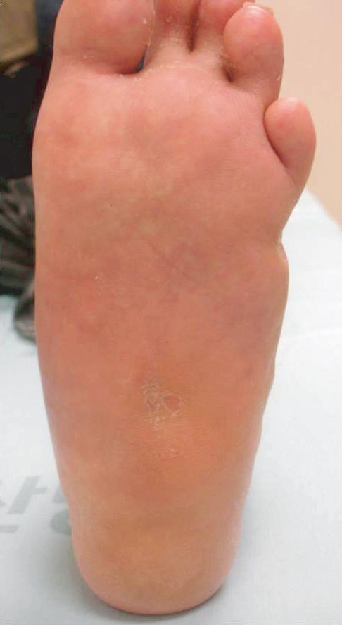 3 Dong-Kyo Seo, et al. Management of Diabetic Foot Ulcer 궤양이 발생한다는 것이다. 샤코씨 관절증이 발생하는 병리 현상 가 많으나 샤코씨 관절증은 정상인 경우가 많다.