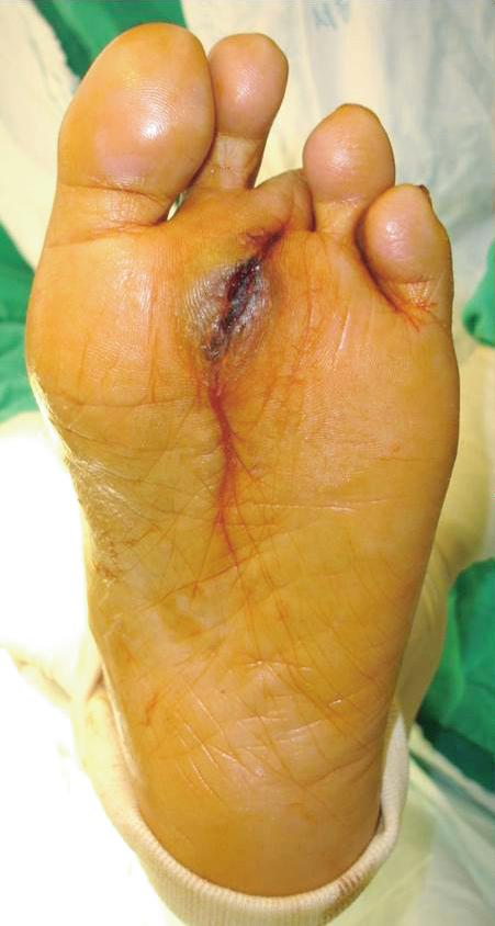 5 Dong-Kyo Seo, et al. Management of Diabetic Foot Ulcer (Fig. 4) 및 아킬레스건 연장술 등이 필요할 수 있으며 이러한 치료 있다. 그러나 이는 수여부의 혈관 상태가 좋아서 혈관 문합술이 가 방법들을 상태에 따라 적절하게 병행하여야 한다.