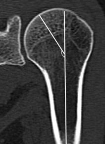 (A) The diameter of the articular surface (a) measured a distance between cartilage edges of the humeral head in the coronal plane.