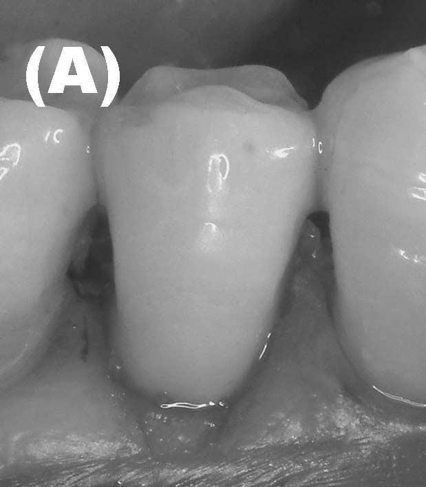 Figure 2. Deterioration of the restorations - An example of marginal discoloration observed in group E (Adper Prompt, no retention groove), (A) baseline, (B) 6-month recall. Table 4.