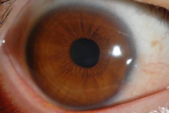 n evaluation of sweating and the pupillary response together with generalized areflexia confirmed the diagnosis of Ross syndrome.