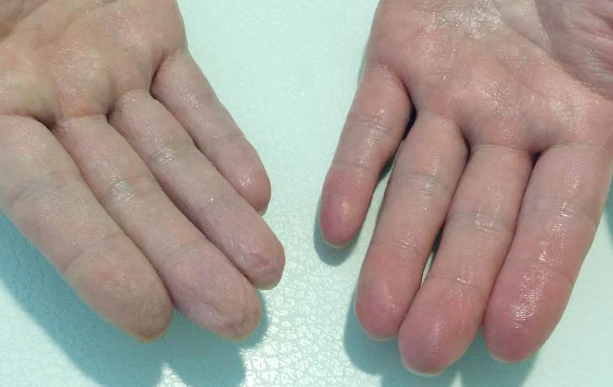 분절무한증과동공부등을주소로내원한로스증후군증례 : 손가락주름유발검사의적용 Figure 3. Evaluation of distal sympathetic denervation.