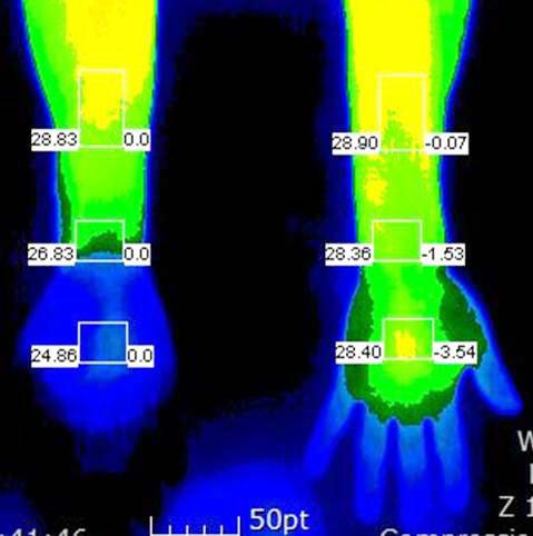 () Skin temperature was higher on the left palm when measured by digital infrared thermal imaging. 우측손에는땀이흥건하였다. 동공의모양이불규칙하였으며, 우측동공은 5 mm로좌측에비해컸다 (Fig. 1-, ).