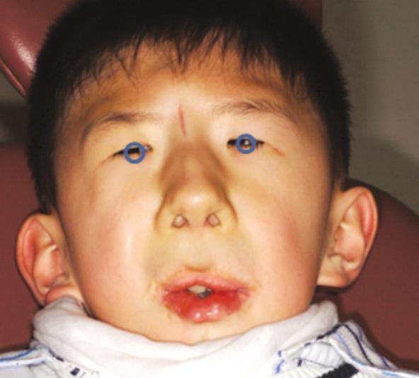 J Korean Acad Pediatr Dent 37(4) 2010 본원에내원한환아는질환의다양한특징들을출생직후부터모두가지고있었고 FSS 로진단되어정형외과,