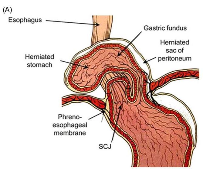 Type of Hiatal hernia Type 2 : 식도주위탈장 (para-esophageal hernia) - 횡격막식도인대의손상은없고,