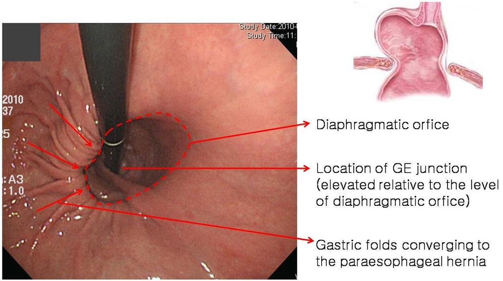 Type of Hiatal hernia Type 3 : Type 1 + Type 2 (mixed) -