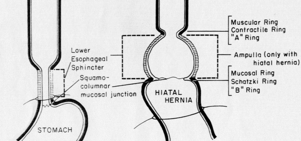 Type of Hiatal hernia Type 1 : 활주열공탈장 (sliding hiatal hernia) - 식도열공주위에서식도를횡격막에부착시켜주는횡격막식도인대 (phrenoesophageal
