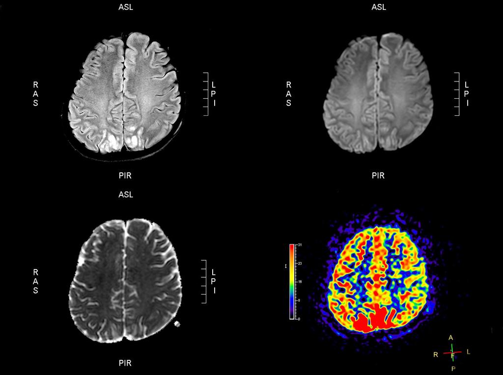 Oh-Young Kwon, et al. Brain lesions attributed to acute seizures A B C D Figure 6. PRES in a brain magnetic resonance imaging from a 26-year-old woman with eclampsia.
