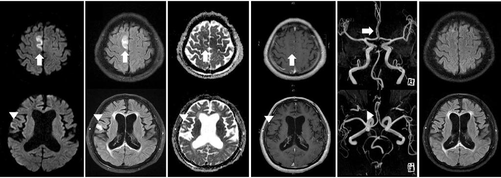 A B C D E F Figure 1. Lesions of seizure induced brain edema in a 64-year-old male.