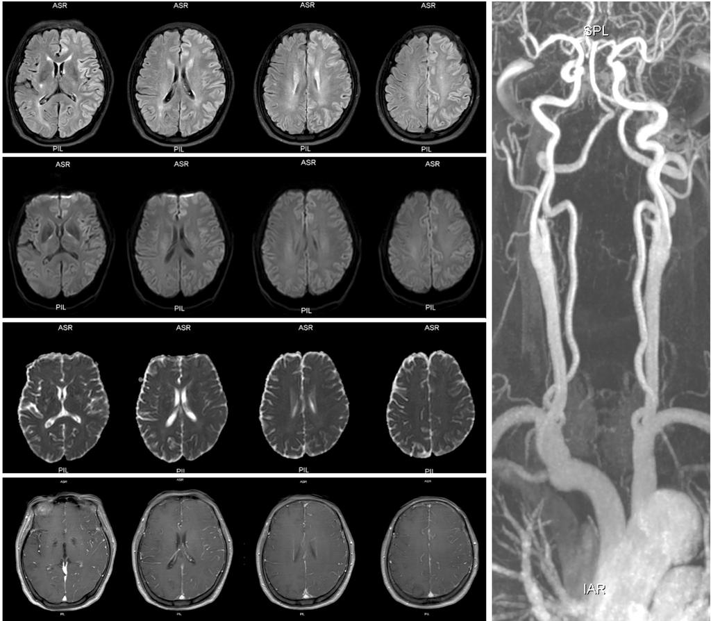 Oh-Young Kwon, et al. Brain lesions attributed to acute seizures A E B C D Figure 2. Brain MRI and MR angiography in a 66-year-old female with acute serial seizures of unknown types.