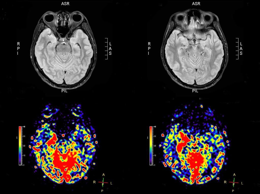 A B Figure 3. Hyperperfusion in a lesion attributed to serial GTC seizures in brain MRI from a 41-year-old man.