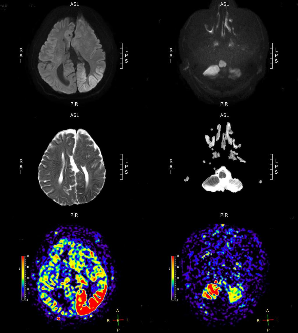 Oh-Young Kwon, et al. Brain lesions attributed to acute seizures A B C Figure 4.