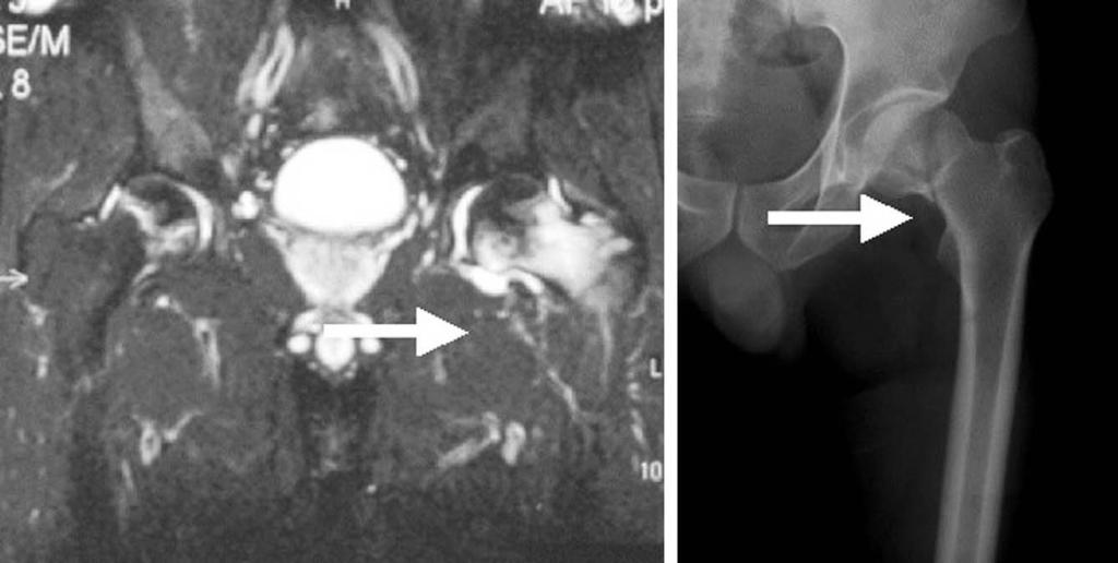 2 병씩일주일에 3회정도마시는약 10 년의과거력갖고있었다. 이학적소견상좌측고관절 Fig. 1. () 59 years old female patient, Simple X-ray of high subcapital right femur head fracture with avascular necrosis.