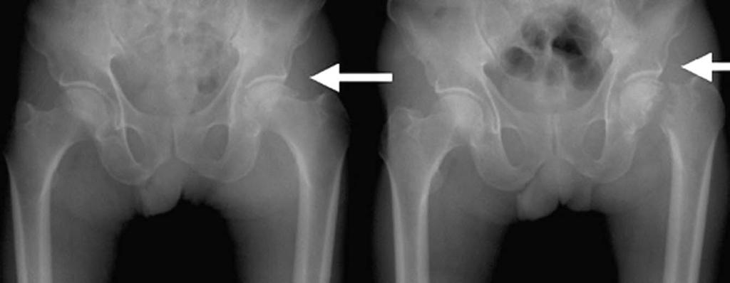 (C) MRI shows fracture of the left femoral head with necrosis and marrow edema of right femur head.