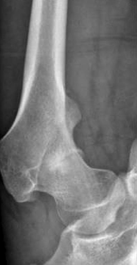 187 Young Adult Femur Neck Fractures A B C Figure 15. A 20-year-old man presented with a painful right hip after a military training.