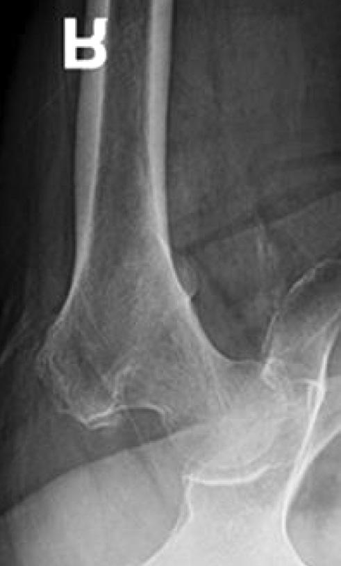 Pauwels는대퇴경부골절선이수평선과이루는각도에따라대퇴경부골절을세가지형으로분류하였다 (Fig. 4).